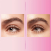 brow-lifting