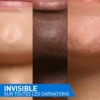 patchs-invisibles